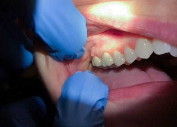 Best Emergency Tooth Extraction in Horn Lake, MS